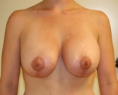 Feel Beautiful - Breast Lift Augmentation San Diego Case 8 - After Photo